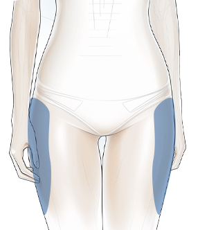 타이트닝 (Tightening) 이미지